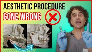 WHY YOUR AESTHETIC PROCEDURE WENT WRONG // Dermal Filler