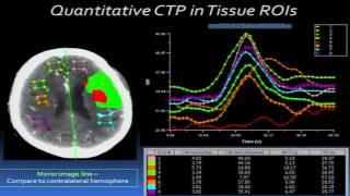 Acute Stroke NeuroIntervention Presented by Sundeep Mangla, M.D.