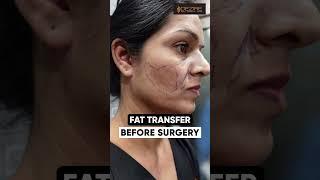 Fat transfer to Cheek | Under eye & Nasolabial Folds #shorts