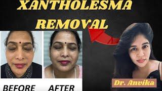 Fat deposits on eyelids / Xantholesma treatments/ 9999 747 717