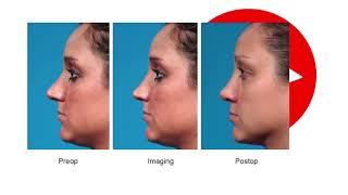 3D-Printed Noses. Plastic Surgery Hot Topics with Rod J. Rohrich, MD