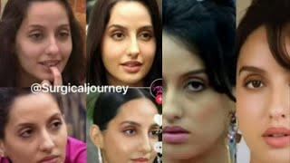 Nora Fatehi Plastic Surgeries Before and After