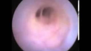 innoMedicus - SalivaScope - Saliendoscopy of the Salivary Gland - Nahlieli 2008_12