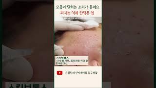 모공 닫아주는 피부과 시술 3종 세트