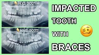 #5 BRACES VISIT PH2                                     Impacted Tooth⏳Times Up!