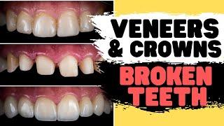 Teeth Bonding vs Porcelain Veneers vs Tooth Crown | Broken Tooth Repair