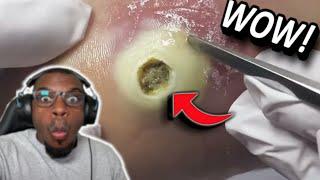 You Won't Believe Your Eyes! Watch the Grossest Pimple Pops of 2023