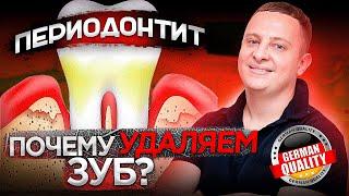 Когда нужно удалять зуб при периодонтите? Немецкий имплантологический центр