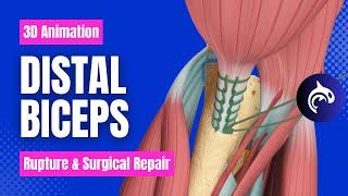 Distal Biceps Rupture and Surgical Repair - 3D Animation