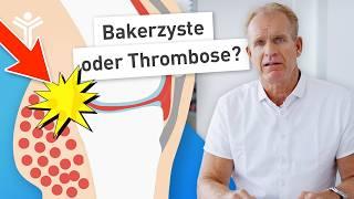 Geplatzte Bakerzyste oder Thrombose? - Mache DAS bei Schmerzen und Schwellungen in der Wade