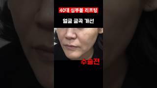 심부볼 얼굴처짐 리프팅 수술 한달 후 #심부볼 #리프팅 #facelifts #shorts #모즈클리닉 *모든 시술/수술은 부작용이 있을 수도 있습니다