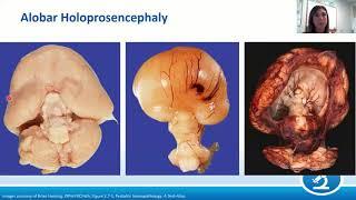 AANP Teaching Rounds - February 24, 2021 - Pediatric Neuropathology: Malformations