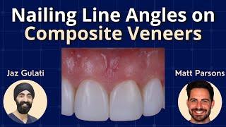 Nailing Line Angles on Composite Veneers - GF007