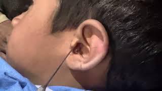 Safe Removal of Ball Bearing from Child’s Ear: Successful ENT Procedure