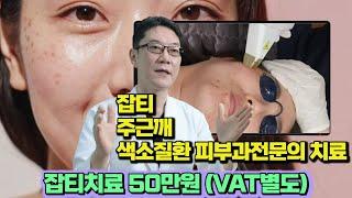 잡티  주근깨 색소질환 치료 몇 번 받아야 할까요? 잡티제거비용 50만원 #잡티#주근깨#색소침착