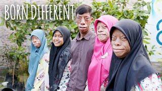 The Family Whose Faces Change Shape | BORN DIFFERENT