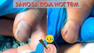 How to get a splinter under a nail? / We take out a big splinter