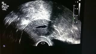 серозометра и синехии полости матки.  serosometer and synechiae of the uterine cavity