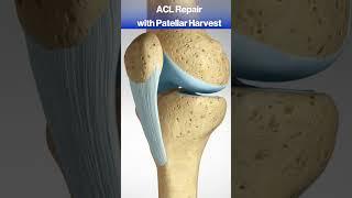 What happens when you tear your ACL? #acl #knee #kneepain