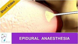 EPIDURAL ANAESTHESIA