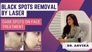 Black Spots Removal With Laser || What Are The Results? || Is It Painful? || Dermatologist Dr.Anvika