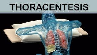 Thoracentesis Medical Animation