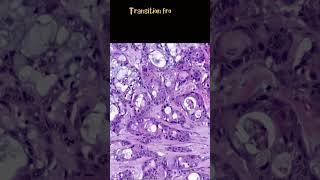 Gastric adenosquamous carcinoma