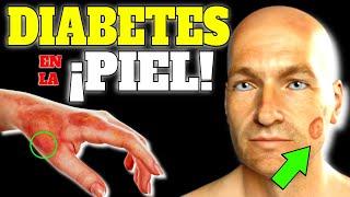 FIRST SYMPTOMS of DIABETES on the SKIN!