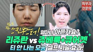 리쥬란 vs 쥬베룩+큐어젯 통증 비교! 스킨부스터 셀프 시술 전후🫶ㅣ노남경의 피부클래스