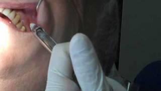 Periodontal surgery in preparation for an implant: Part I/5