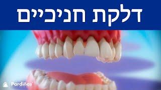 © דלקת חניכיים - מה זה