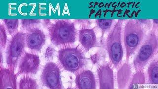 Eczema/Atopic, Contact Dermatitis, etc: Spongiotic Dermatitis Pattern - Inflammatory Dermpath Basics