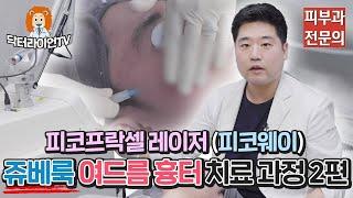 닥터라이언이 직접 보여주는 쥬베룩 여드름 흉터 치료 과정 2편 (피코웨이)