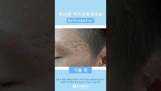 여드름 롤링성 흉터 / 쥬브젠 1번이면 끝! / 쥬브젠자가진피재생술 / #shorts