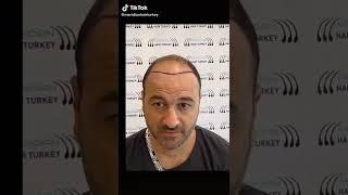 Hair implant results /MERİDİAN HAİR TURKEY