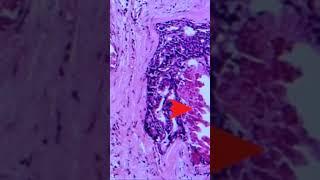 Ductal Carcinoma in Situ of Breast - Pathology #shorts