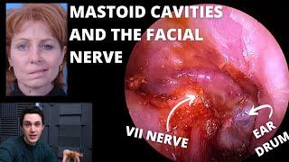 Mastoid Cavity Ear Surgery & The Facial Nerve Explained