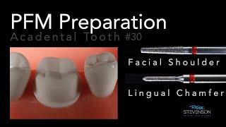 PFM Preparation - Acadental Tooth #30 | Dr. Richard Stevenson