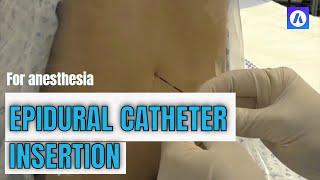 Epidural catheter insertion