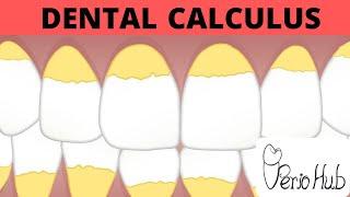 Dental Calculus (Part 1) ‖ Dental Calculus Made Easy ‖ Perio Hub ‖ Dr Sneha