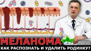 Меланома и злокачественные родинки: Как распознать и удалять?