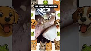 Wow! #pimples #pimple #pimplepopper #shortsfeed #shortvideo #shorts #short #youtube #youtubeshorts