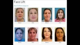 Best Facelift Surgery Doctor in Boca Raton | Facial Plastic Surgeon FL