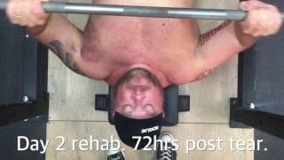 Matt Reynolds Torn Pec Rehab - Week 1 - Starr Protocol