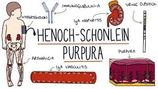 Henoch-Schonlein Purpura: Visual Explanation for Students