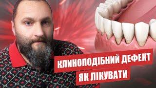  Що таке клиноподібний дефект зубів та як його лікувати