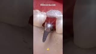 DZirconia.com Формирователи Десны Straumann. Установка формирователя Десны в имплант #имплантация