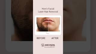 Men’s Facial Laser Hair Removal in Toronto