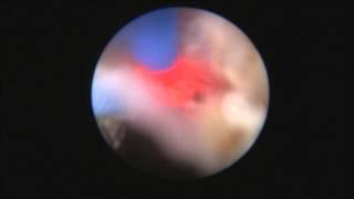 Thulium laser urethrotomy (03.02.2015), Dr. Farid Gadimaliyev, Custom Hospital, Baku, Azerbaijan