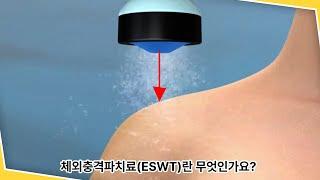 어깨 석회건염 극복: 체외 충격파 치료의 효과  Overcoming Shoulder Calcific Tendinitis: The Power of Shockwave Therapy